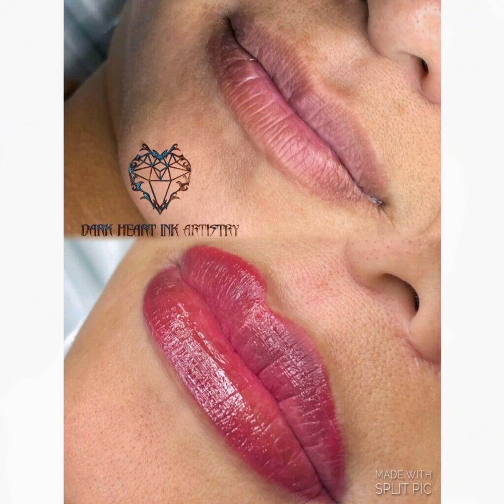 A woman's lips before and after lip injections.