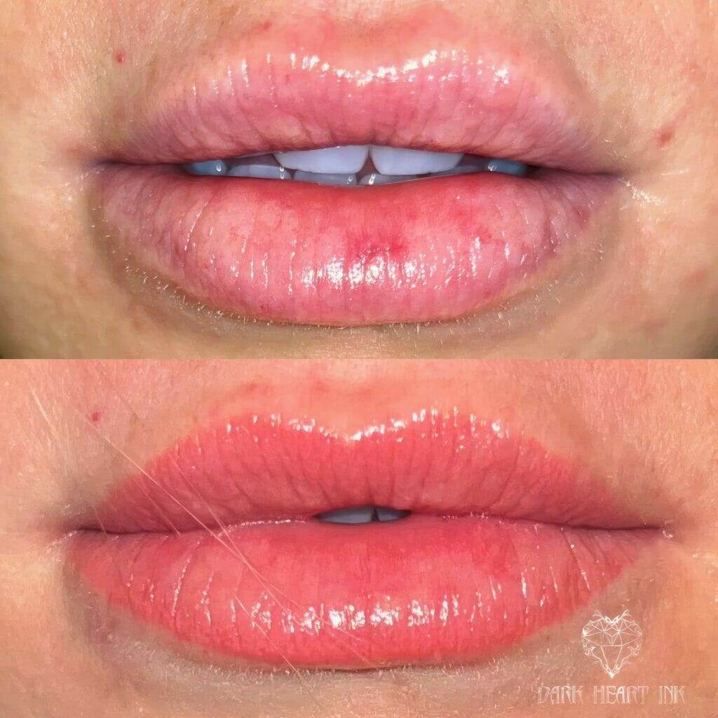 Amy's lips before and after lip injections.