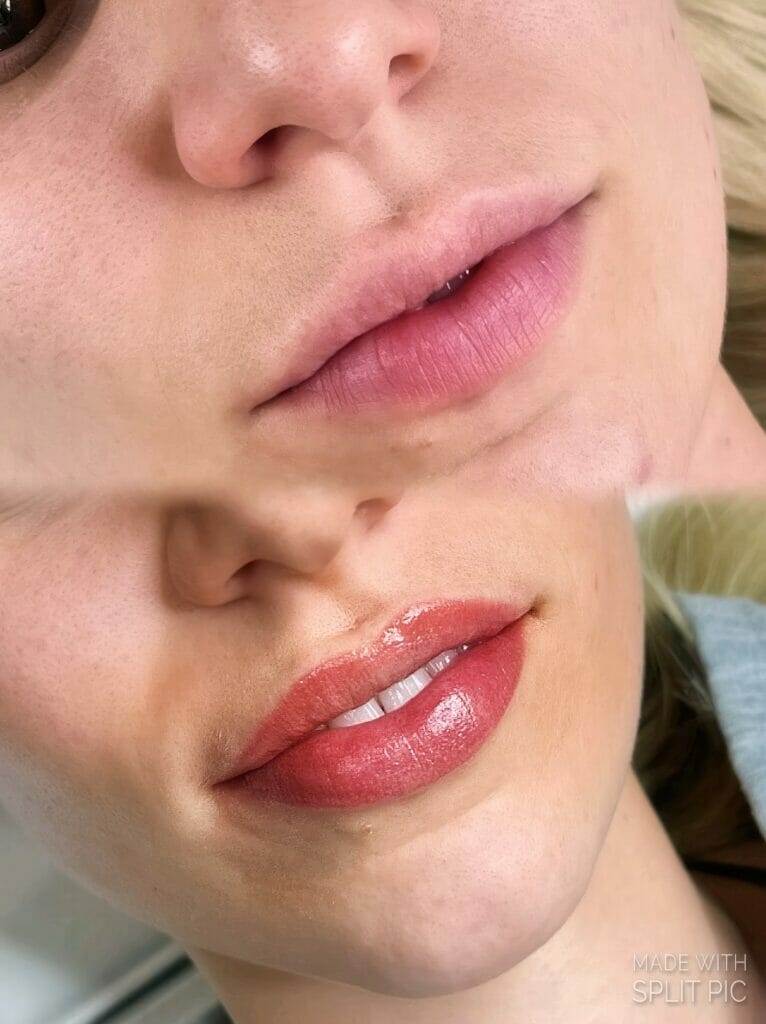 A woman's lips transformed with lip injections.